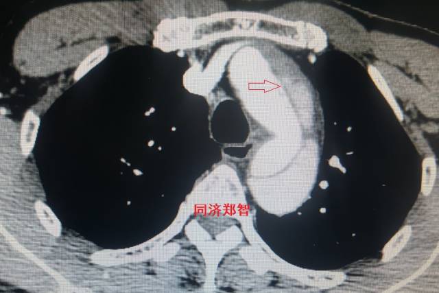 主动脉夹层cta能扫描出来吗,急性主动脉夹层cta影像诊断与鉴别
