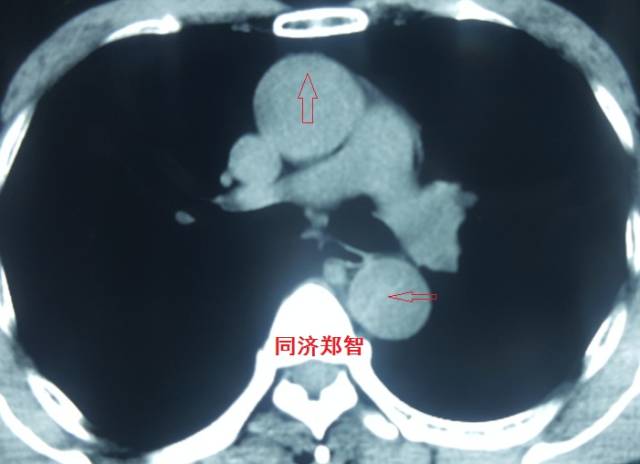 主动脉夹层cta能扫描出来吗,急性主动脉夹层cta影像诊断与鉴别