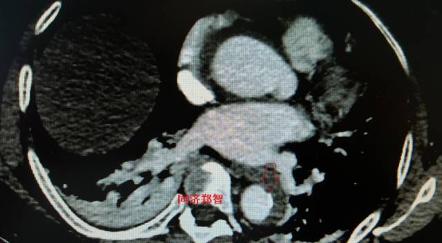 主动脉夹层cta能扫描出来吗,急性主动脉夹层cta影像诊断与鉴别