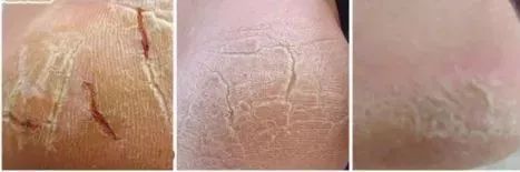 足部护理加长加热脚套,足部护理脚趾套品牌