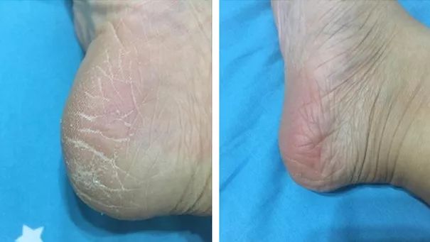 足部护理加长加热脚套,足部护理脚趾套品牌