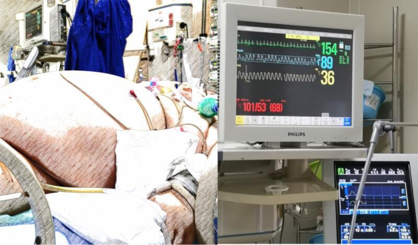 体重340斤，血脂高到仪器爆表！压塌CT机，瑞金医护团队成功救治重症急性胰腺炎患者