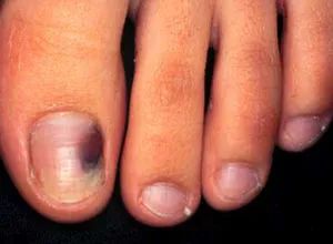 六种被误认为灰指甲的疾病,得了灰指甲最忌讳的是什么