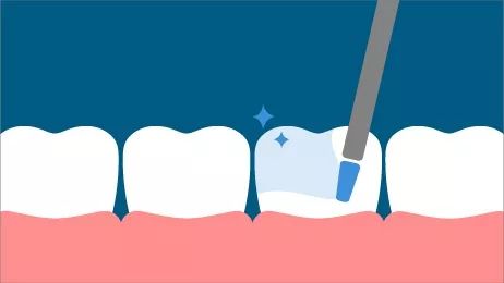 孩子蛀牙不做根管治疗可以吗,小孩蛀牙不补影响吗