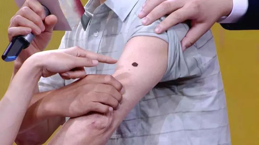 黑痣长在同一个地方的几率有多大,身上2个部位长黑痣当心癌变