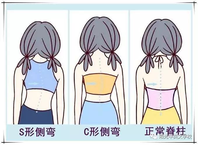 站姿不对会出现脊柱侧弯,坐姿不正确导致脊柱侧弯视频