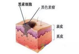 黑痣长在这几个部位需要提高警惕,凸出来的黑痣容易癌变吗