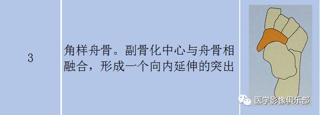 足副骨综合征,副舟骨疼痛综合征