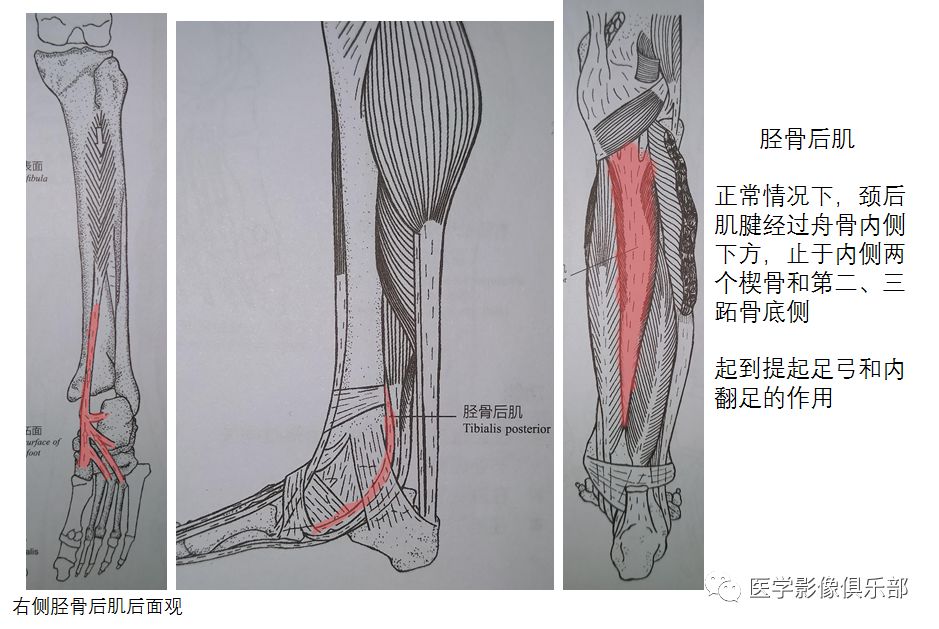 足副骨综合征,副舟骨疼痛综合征