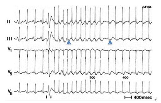 心电图显示窦性心动过速怎么办,一张心电图可以诊断心脏过缓吗