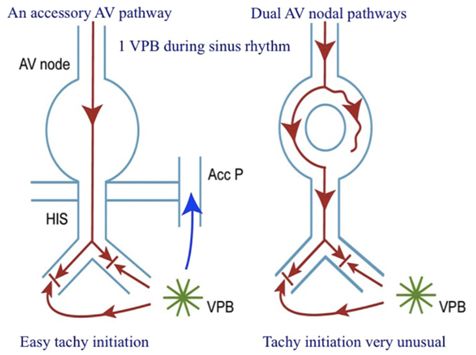 心电图显示窦性心动过速怎么办,一张心电图可以诊断心脏过缓吗
