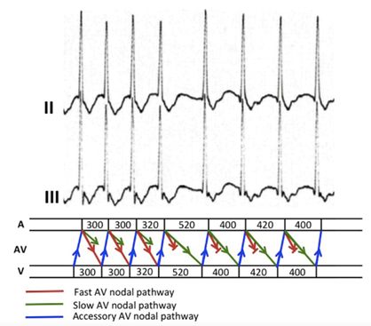 心电图显示窦性心动过速怎么办,一张心电图可以诊断心脏过缓吗