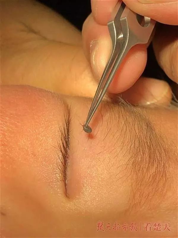 2岁小孩眼睛上突然长了一颗黑痣,2岁小孩眼皮上长了个红疙瘩