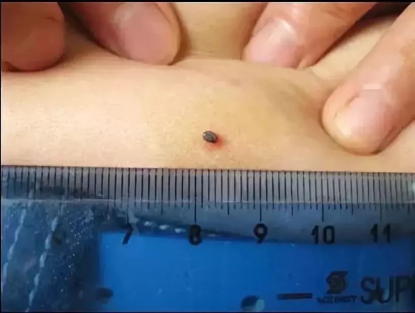 2岁小孩眼睛上突然长了一颗黑痣,2岁小孩眼皮上长了个红疙瘩