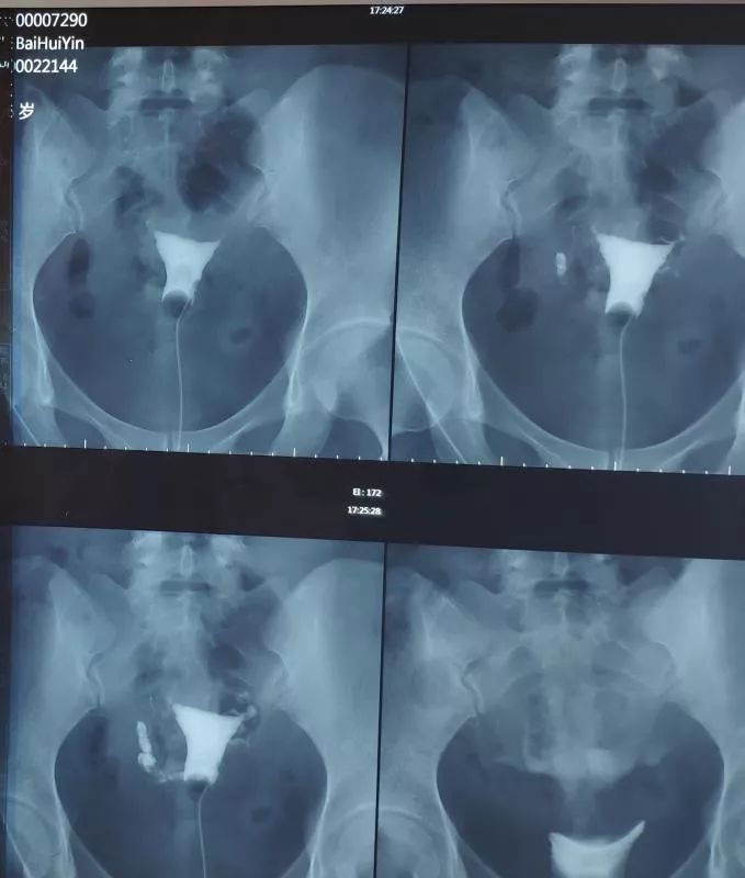 生育喜报,不孕症患者怀孕的喜讯