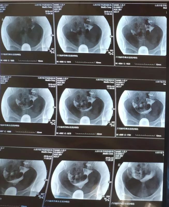 生育喜报,不孕症患者怀孕的喜讯