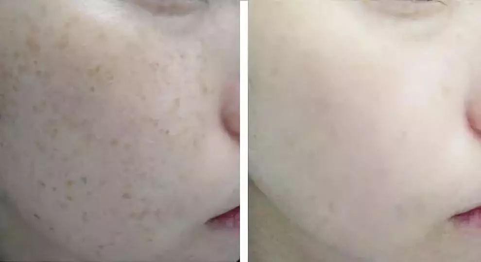 坚持7天的细纹消失,没有细纹但是有斑点