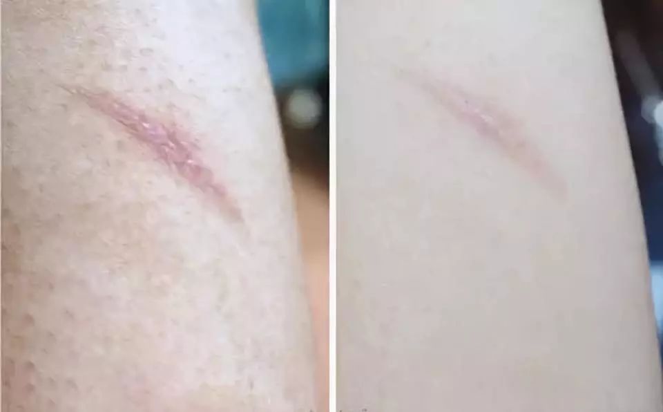 坚持7天的细纹消失,没有细纹但是有斑点