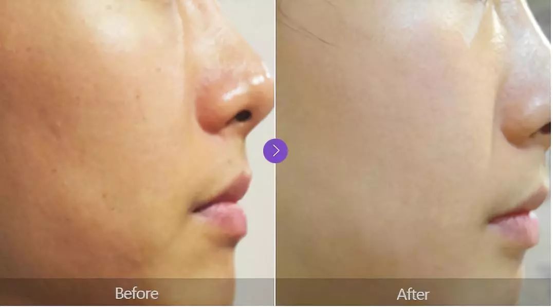 坚持7天的细纹消失,没有细纹但是有斑点