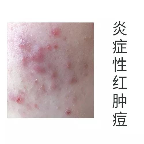 为什么做了针清效果很差,针清之后做光子效果会更好吗