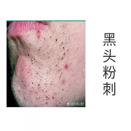 为什么做了针清效果很差,针清之后做光子效果会更好吗