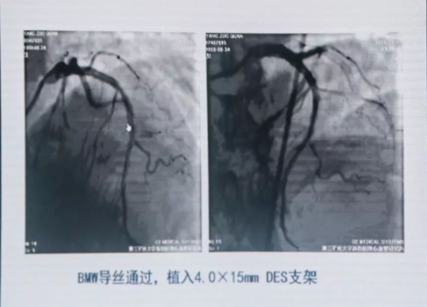 CCIF2019丨黄岚教授：急性/亚急性支架血栓的处理策略