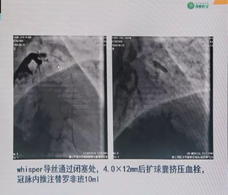 CCIF2019丨黄岚教授：急性/亚急性支架血栓的处理策略