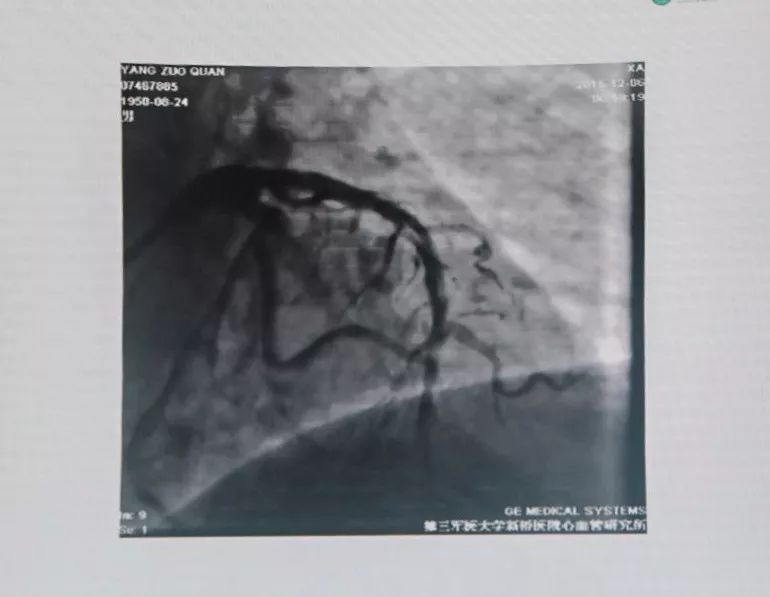 CCIF2019丨黄岚教授：急性/亚急性支架血栓的处理策略