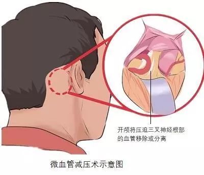 北京天坛医院三叉神经痛专家,天坛医院三叉神经手术费用