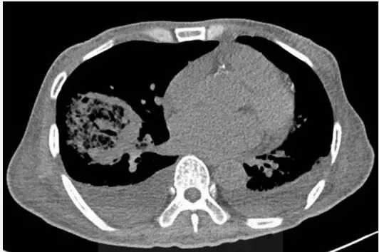 肺空洞性疾病的鉴别,肺空洞多见于哪些疾病