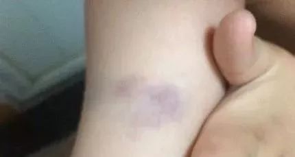 身上出现淤青怎么快速消除,身上出现淤青该怎么快速消除