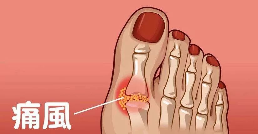 【有肾说甚】第8期｜大量饮水可缩短痛风发作时间……原来还有这些方法可治疗高尿酸血症