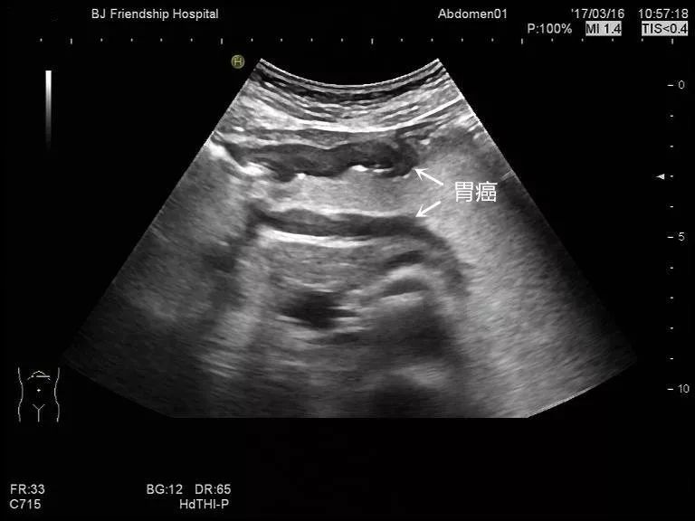 刚做完胃镜能做胃超声吗,友谊消化科普