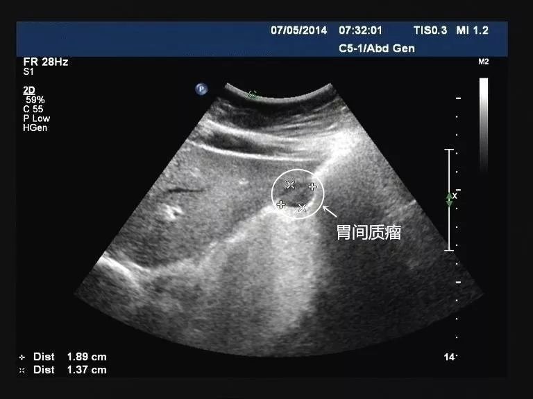 刚做完胃镜能做胃超声吗,友谊消化科普