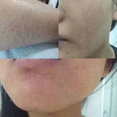 螨虫在脸上爬好不好,螨虫爬过的东西还能用吗