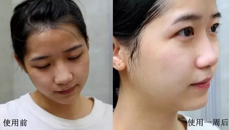 螨虫在脸上爬好不好,螨虫爬过的东西还能用吗