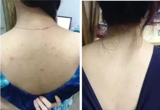 螨虫在脸上爬好不好,螨虫爬过的东西还能用吗