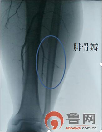 诚德骨科医院能否治疗股骨头坏死,山亭诚德骨科医院骨一科