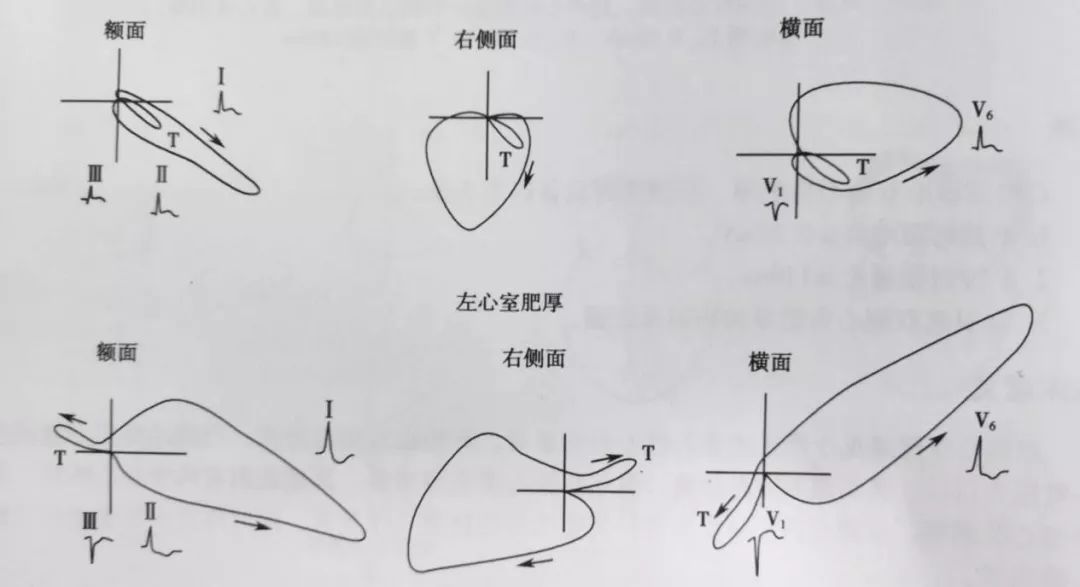 st压低t波倒置严重吗,st段压低和t波倒置