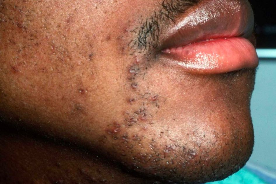 哪种皮肤病容易被误判为银屑病,容易被误诊为疥疮的皮肤病