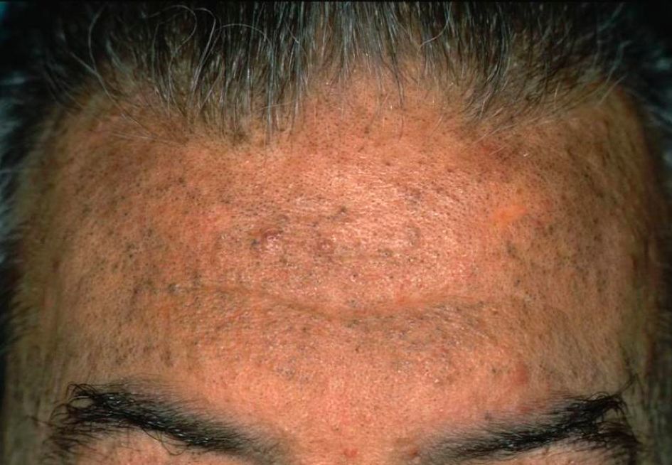 哪种皮肤病容易被误判为银屑病,容易被误诊为疥疮的皮肤病