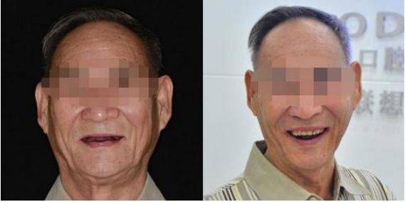 无锡缺牙优惠补贴多少钱,缺牙人士看过来种牙补贴免费领