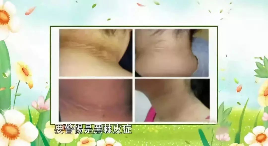 突然发现脖子上长了个黑色瘤,如何判断脖子上是否有肿瘤