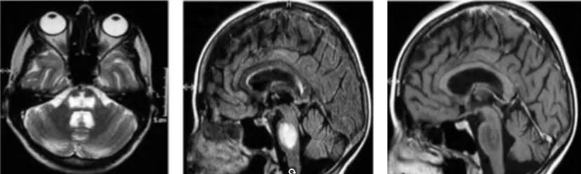 低钠血症补钠后持续降低,低钠血症如何补钠指南