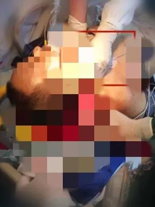 惊险男子身悬18楼外防火奋力营救,惊险浙江男子手被锯断不停喷血