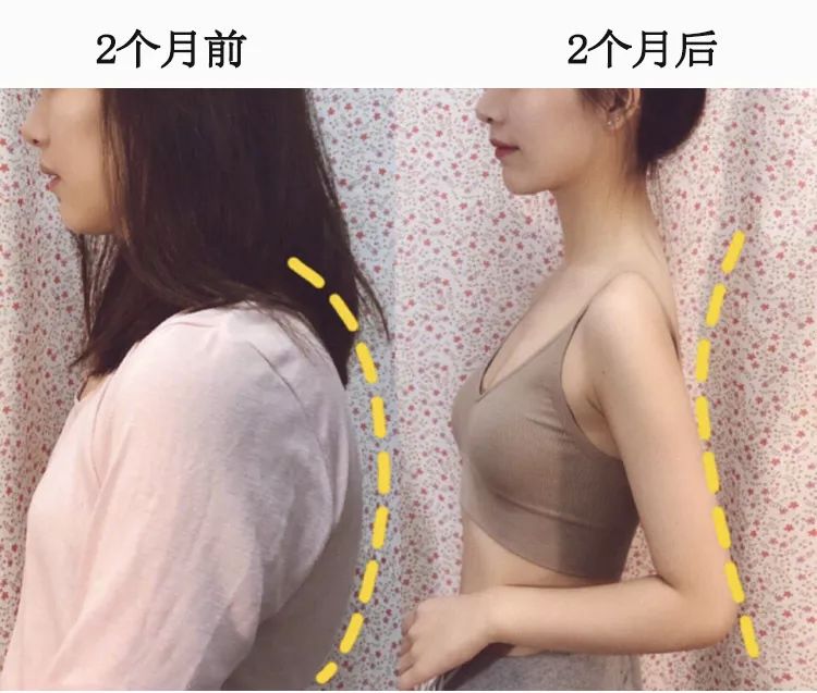 含胸驼背最损气质手把手教你纠正,含胸驼背如何改善提升气质