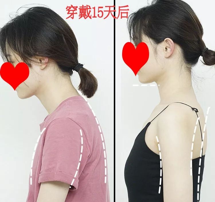 含胸驼背最损气质手把手教你纠正,含胸驼背如何改善提升气质