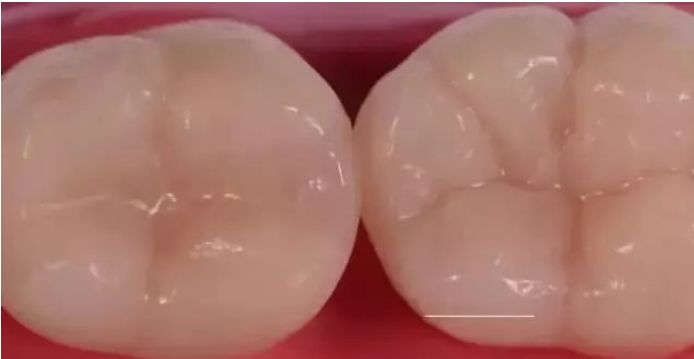 一颗蛀牙修补要多久,一颗蛀牙拔了能直接矫正吗