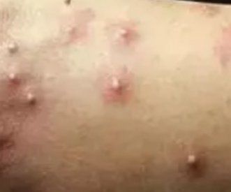 广西一女子被蚂蚁咬伤后不幸身亡,女子被蚂蚁咬伤后续