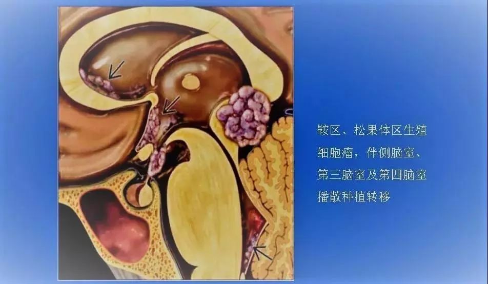 颅内生殖细胞瘤晚期活多久,认识儿童眼部癌症